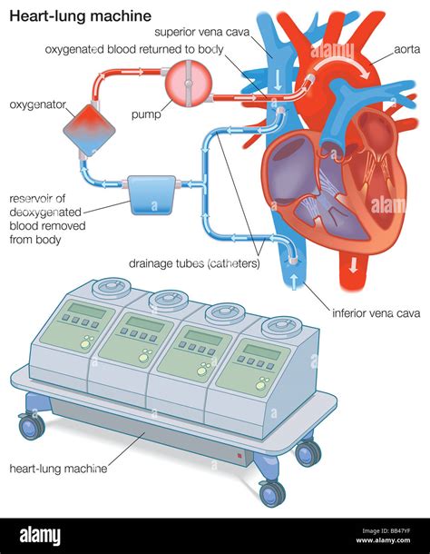 Heart Lung Machine Diagram - Hanenhuusholli