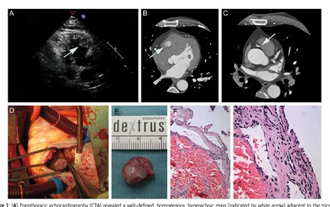 Figure 1 From Cardiac Haemangioma With Coronary Pulmonary Artery