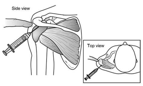 Shoulder Impingementrotator Cuff Tendinitis Orthoinfo Aaos