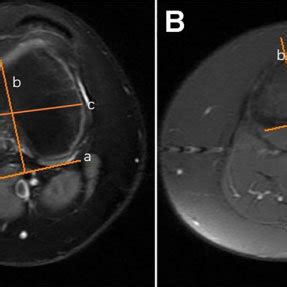 A And B Cartilaginous Tibial Tubercle Trochlear Groove TT TG