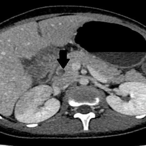 Contrast Enhanced Abdominal Computed Tomography Dilated Common Bile