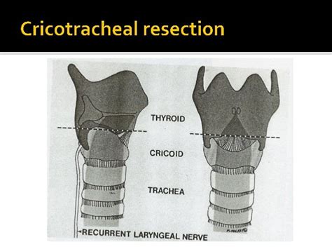 Airway Stenosis Resection And Ltp Dchhetri11 19 08