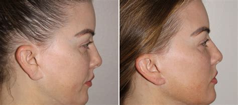 Earlobe Repair Photos - SoCal Aesthetic Surgery