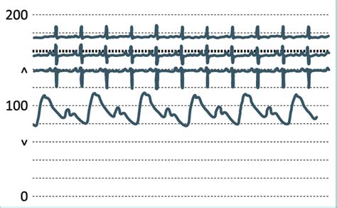 Pulsus Alternans In A Patient With Severe Left Ventricular Systolic