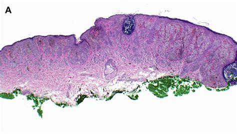 Dysplastic Nevi Surgical Pathology Clinics