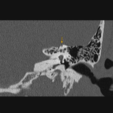 Dehiscence Of Superior Semicircular Canal Image