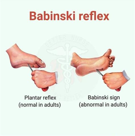 Normal Plantar Reflex