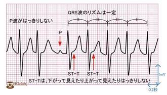 発作性上室頻拍2 Avnrtの波形と特徴 1 不整脈の種類 Ecg Cafe