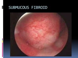 Hysteroscopy | PPT