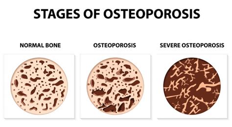 Osteoporosis vs. Osteopenia