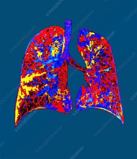 Healthy lungs, CT scan - Stock Image - F039/3319 - Science Photo Library