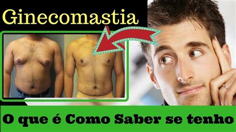 Ginecomastia Masculina Quais Os Tipos E Tratamento Procedimentos De