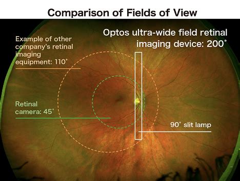 Optomap Retinal Exam