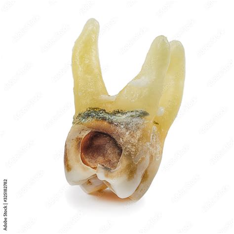 Affected By Caries Destroyed With A Large Cavity Removed Human Tooth