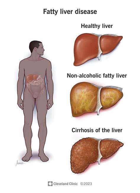 Fatty Liver Disease