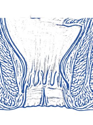 Dr Alfredo Trive O Fisura Anal