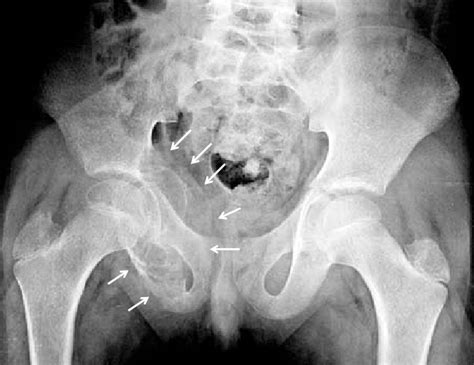 Anteroposterior Radiograph Of The Pelvis Of A 16 Year Old Boy With An