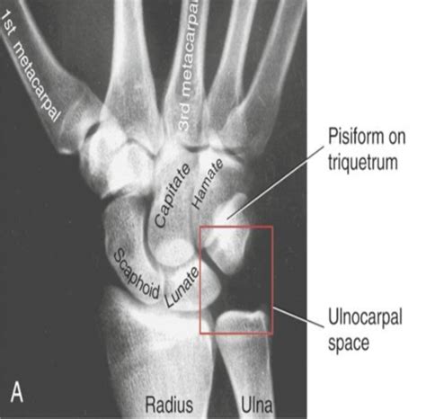 Wrist Ligaments Biomechanics Hand Orthobullets