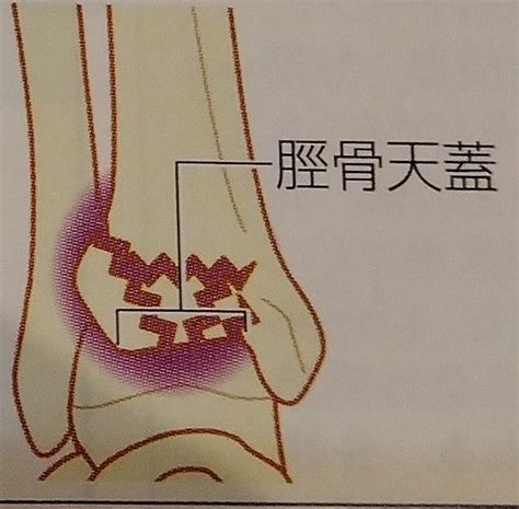 足関節周辺の骨折 | まことの気になる事！