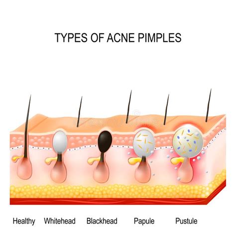 Pimple Anatomy