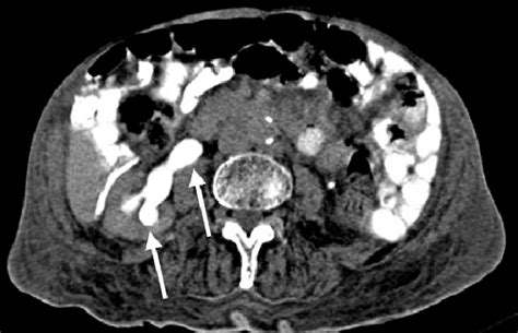 A Axial Ct Image Of The Upper Abdomen Delayed Phase Showing Right