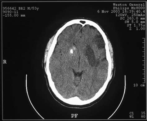 Stroke Patofisiologi Diagnosis Penatalaksanaan Alomedika