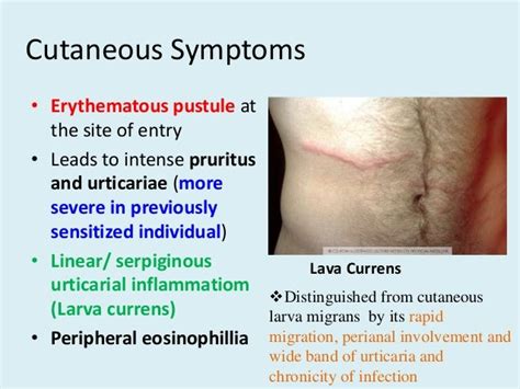 Strongyloidiasis