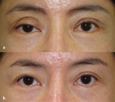 18 Management of Double-Eyelid Surgery Complications | Plastic Surgery Key