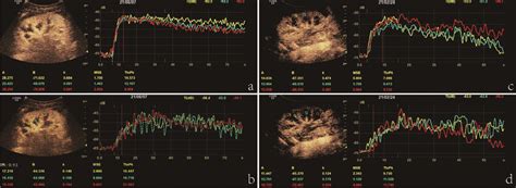 Quantitative Analysis Of Contrast Enhanced Ultrasonography Ceus