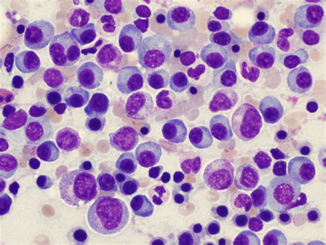 Multiple Myeloma Stepwards