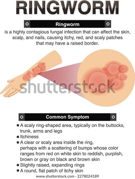 Informative Symptoms Ringworm Illustration Stock Vector (Royalty Free) 2278024189 | Shutterstock