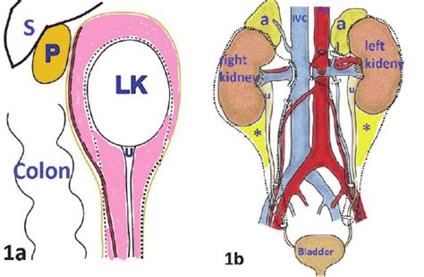 Schematic Planes Of Dissection During Various Nephrectomies 1a