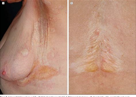 Figure 1 From Pulsed High Dose Corticosteroids Combined With Low Dose