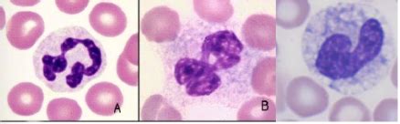 Clinical Pathology Exam I Leukocyte Abnormality Pictures Flashcards