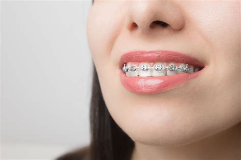 Clear Aligners Vs Braces The Differences Between Them 🦷