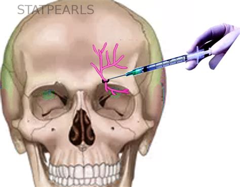 Supraorbital Nerve Block Treatment And Management Point Of Care