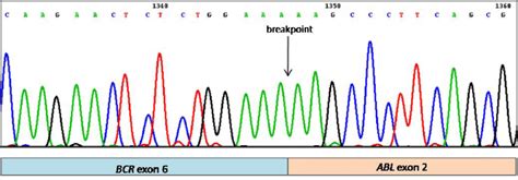 Sequencing Analysis Confirmed A Rare E A Bcr Abl Fusion Transcript