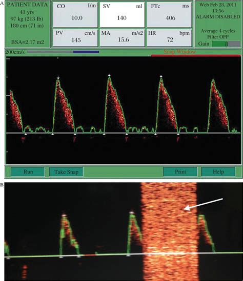 Figure From Comparing A Non Invasive Hemodynamic Monitor With