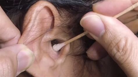 Dry Earwax Removal Ear Cleaning Using Cotton Tipped Applicator YouTube