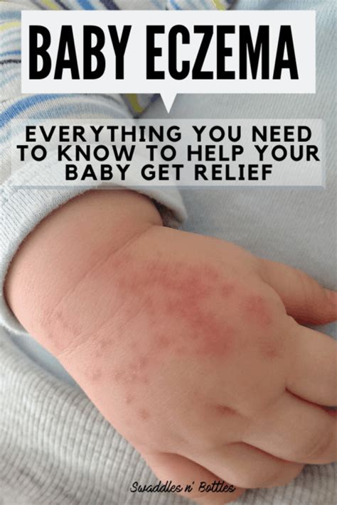 Baby Eczema: Causes and Remedies - Swaddles n' Bottles