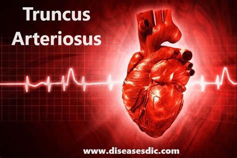 Truncus Arteriosus Types Causes And Prevention