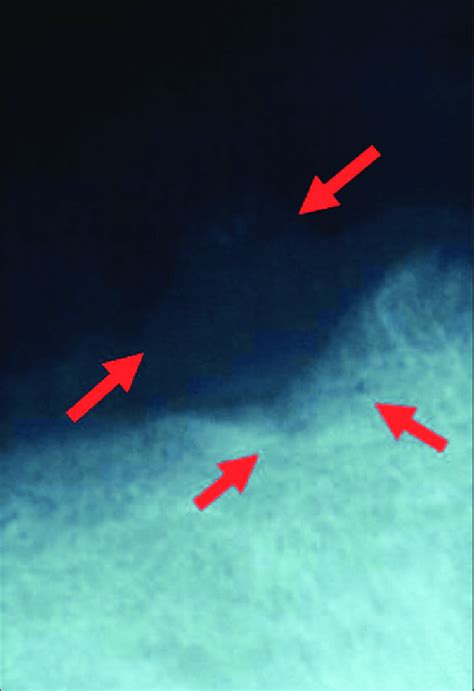 Periapical radiograph showing evidence of a radiolucent lesion with... | Download Scientific Diagram