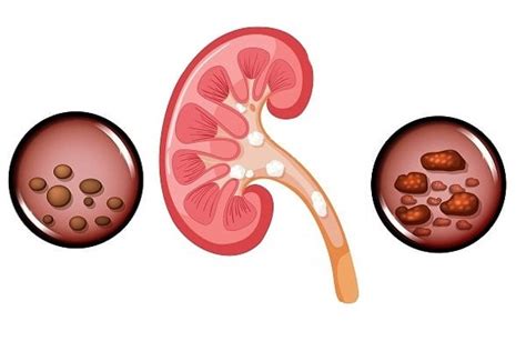 Calcium Kidney Stones: Causes, Symptoms, and Treatment