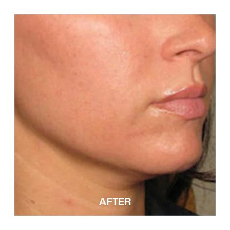 Non Surgical Facelift Liverpool ULTRA QPRO Liverpool