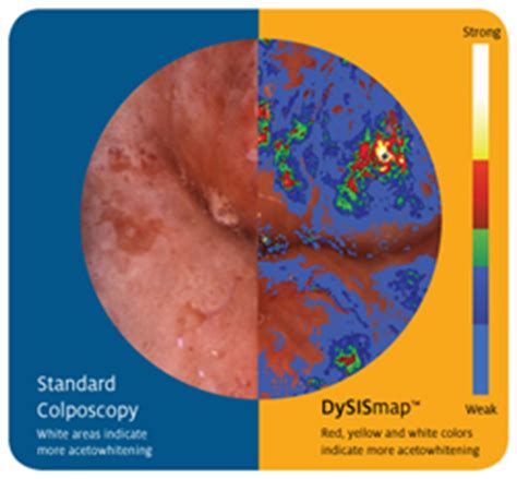 Dysis Announces Preliminary Findings From Largest U S Colposcopy