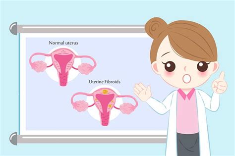 Uterine Fibroid: Causes, Symptoms, Treatment