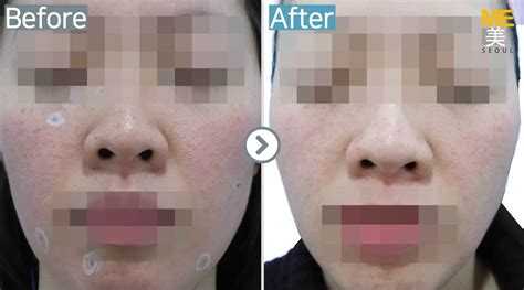 Mole removal - ME CLINIC SEOUL