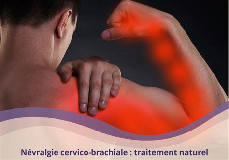 Névralgie cervico brachiale le traitement naturel