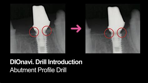 Dionavi Drill Introduction Abutment Profile Drill Youtube