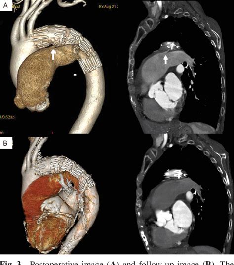 Figure 3 From Use Of A Stent Graft For Patent Ductus Arteriosus In An Octogenarian Eliminates